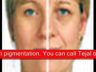 chemical skin peel brighton