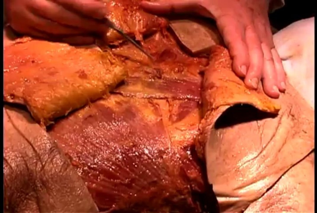 01 - Skin and subcutaneous tissue of trunk and upper thigh