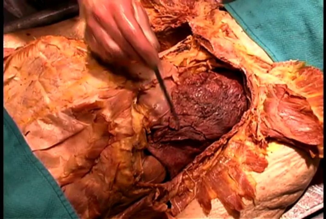 Dissection04 - Lungs and Pleural Sacs