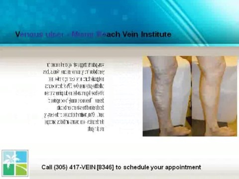 Find best Vein treatment in South Florida - miamibeachvein.com