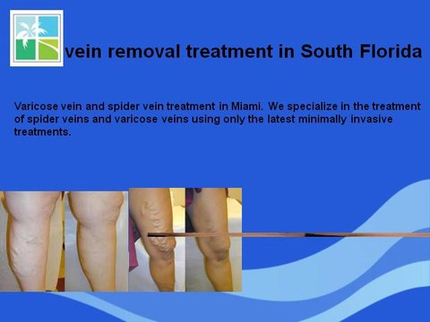 South Florida best vein removal treatment doctor - miamibeachvein.com