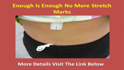 How Do I Get Rid Of Stretch Marks