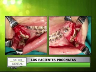 Download Video: Salud Dental: ¿Qué tratamientos requieren los pacientes prognatas?