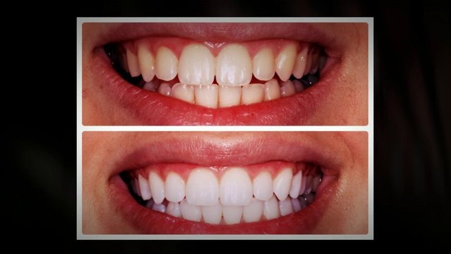 Sonoma Smiles Teeth Whitening- Rohnert Park, CA