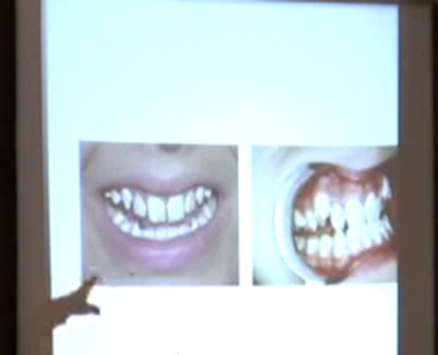 Dr. James Beck Fluoride Discussion