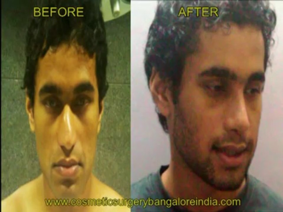 Rhinoplasty: "The Nose Job" at Bangalore,India