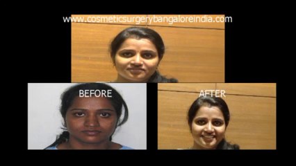 Nose correction(Rhinoplasty) Bangalore,India