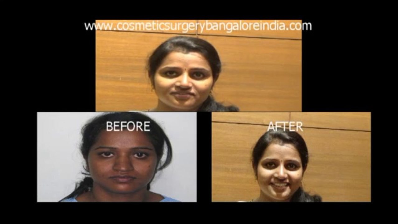 Nose correction(Rhinoplasty) Bangalore,India