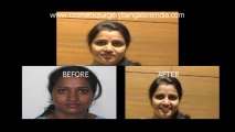 Nose correction(Rhinoplasty) Bangalore,India