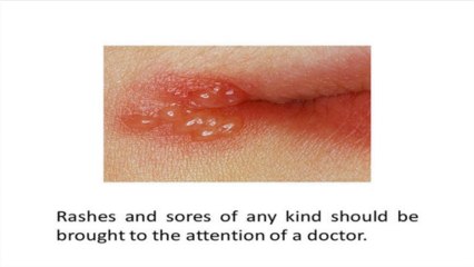 Telling the Difference Between Jock Itch and Herpes