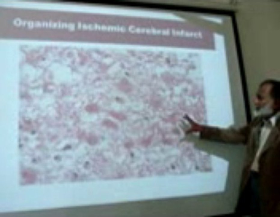 Infarction Part 2: Lecture by Dr. Ahmad Din Anjum (Pathology)