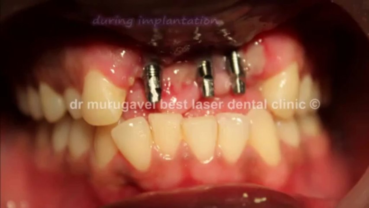 Young patient-Lost teeth in ACCIDENT-FIXED TEETH WITH DENTAL IMPLANTS_2