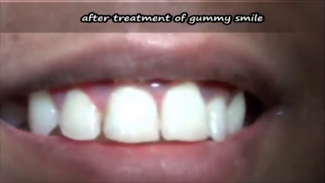 VIDEO-Lip repositioning surgery by laser for GUMMY SMILE CORRECTION