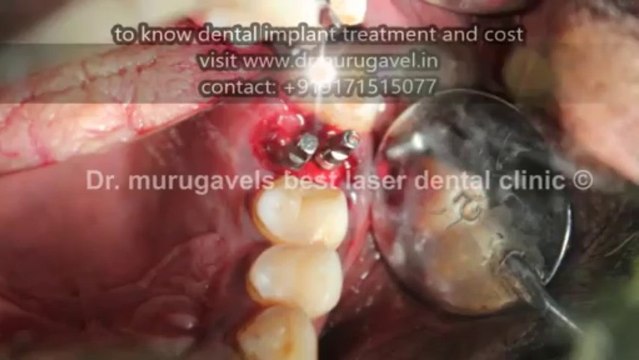 Upper single molar extraction of 2 BCS implant placement -photos