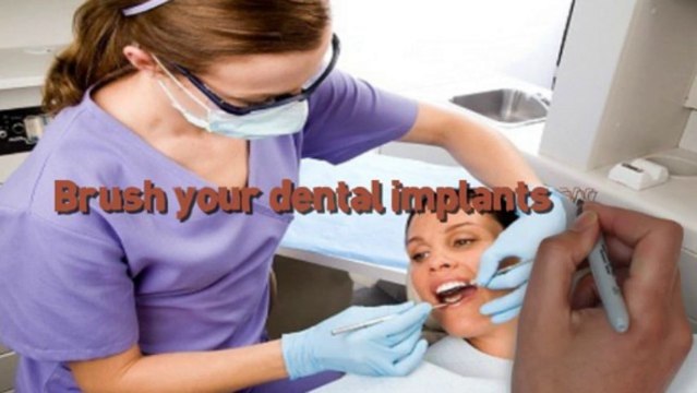 5 Things that You Should Know before Getting Dental Implants