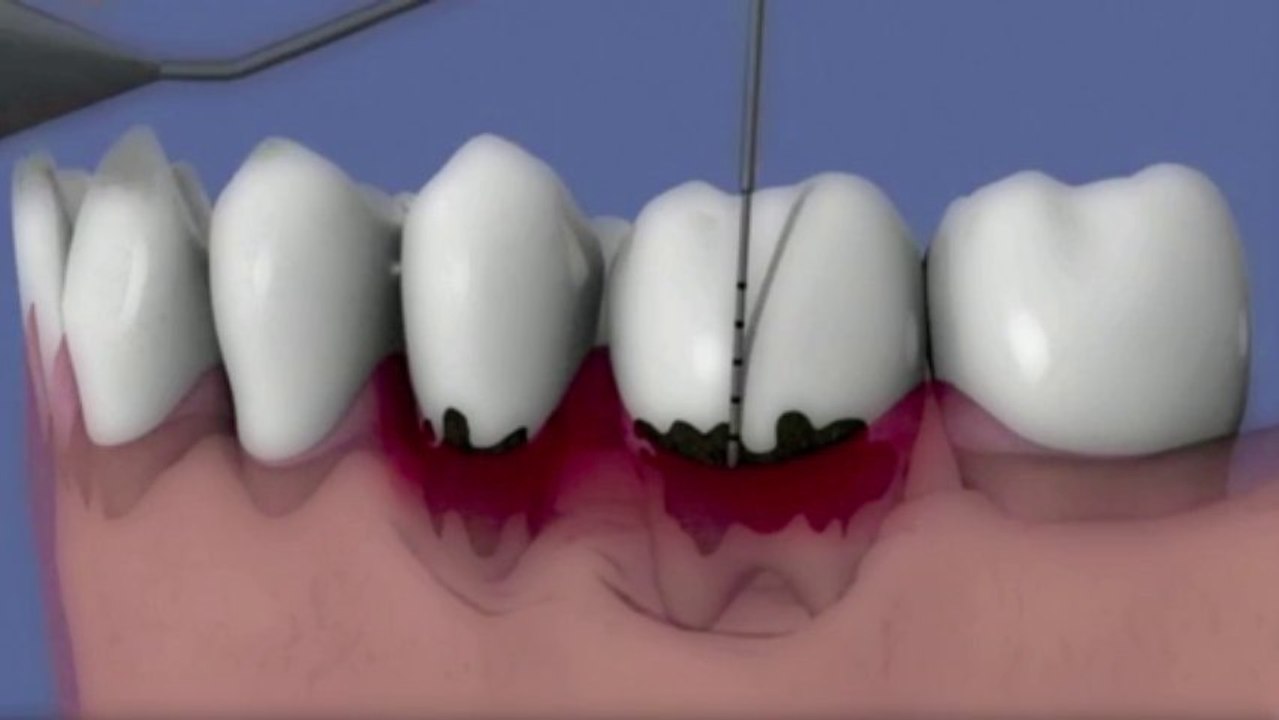 Parodontite et formation de la poche parodantale (grand) fc