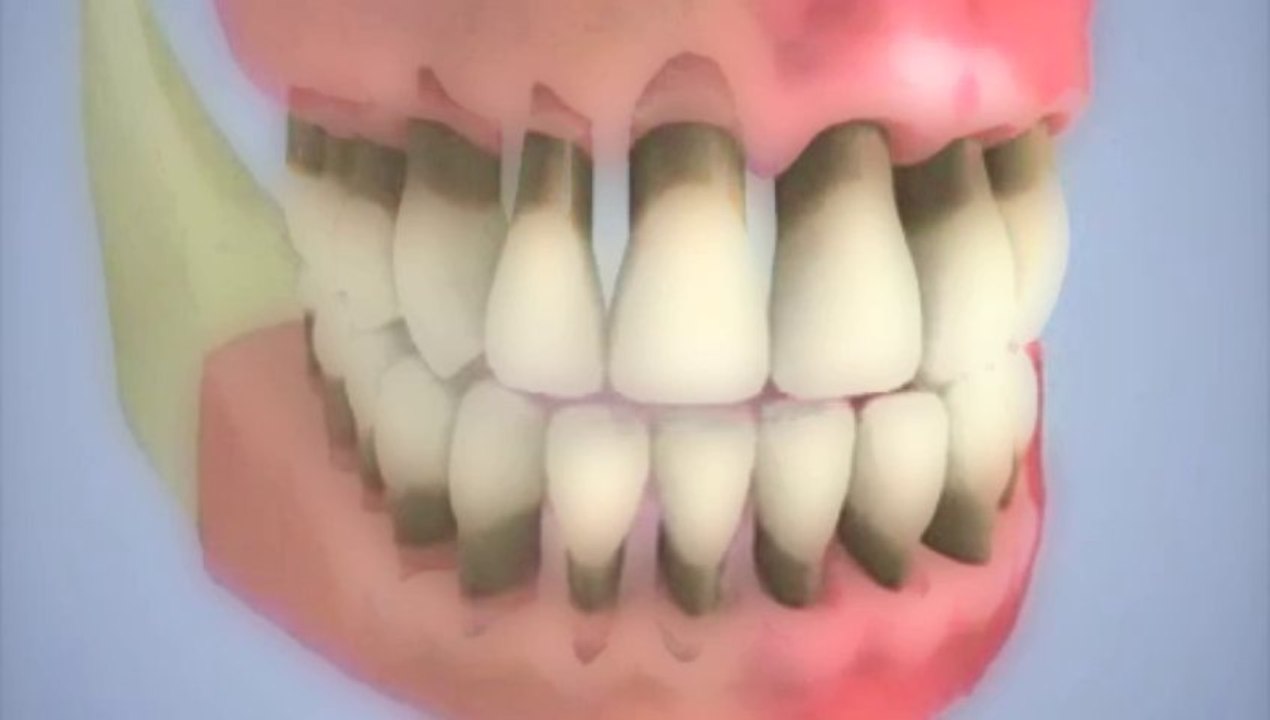 Recession gengivale (pour portable)