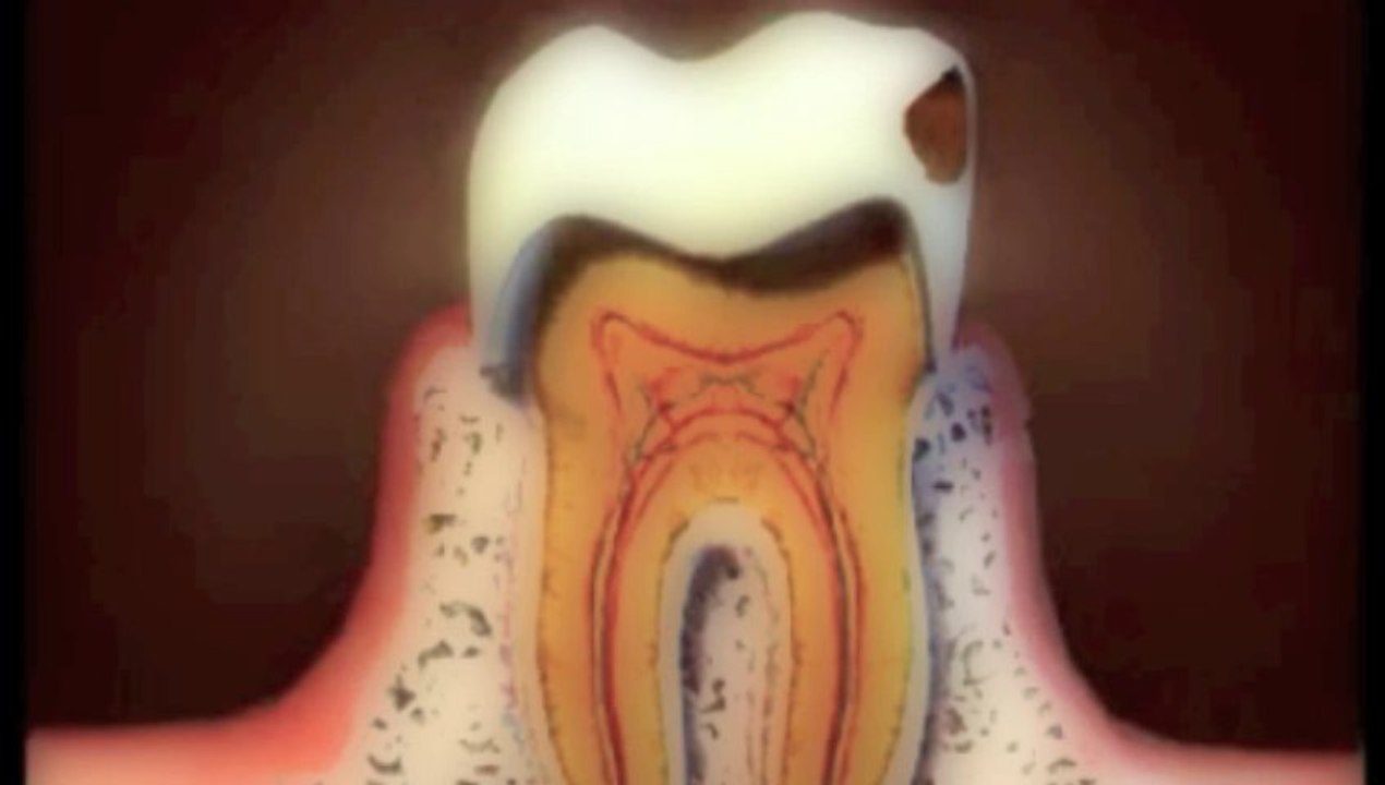 La carie (pour portable) 2