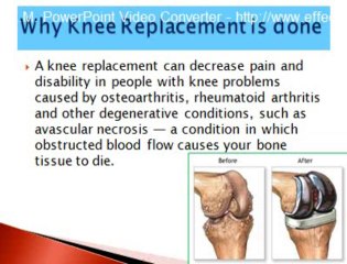 Knee Replacement Surgery in India