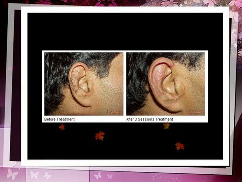 Hair Removal Treatment, Laser Hair Removal Benefits, Side Effects