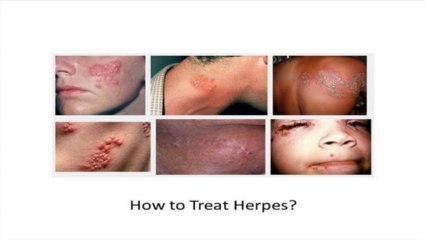 The Signs of Herpes