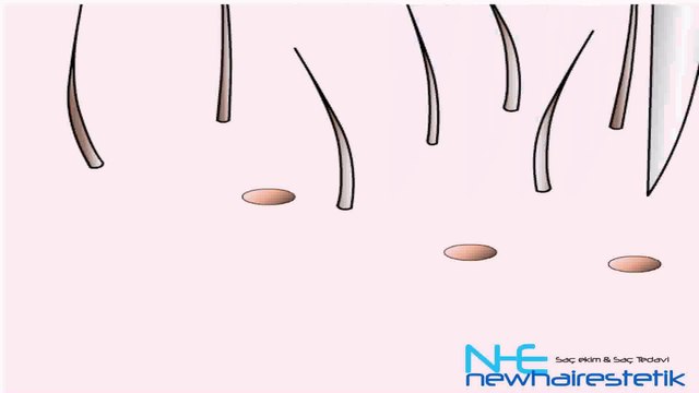 Saç Ekimi Videosu - Hair transplantation Turkey New Hair Estetik