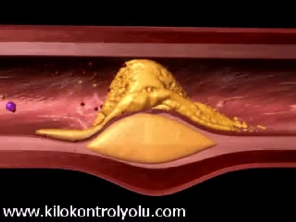 Damar Tıkanıklığını Önlemede Omega 3 Desteğinin Önemi, 0536 612 9009, www.kilokontrolyolu.com