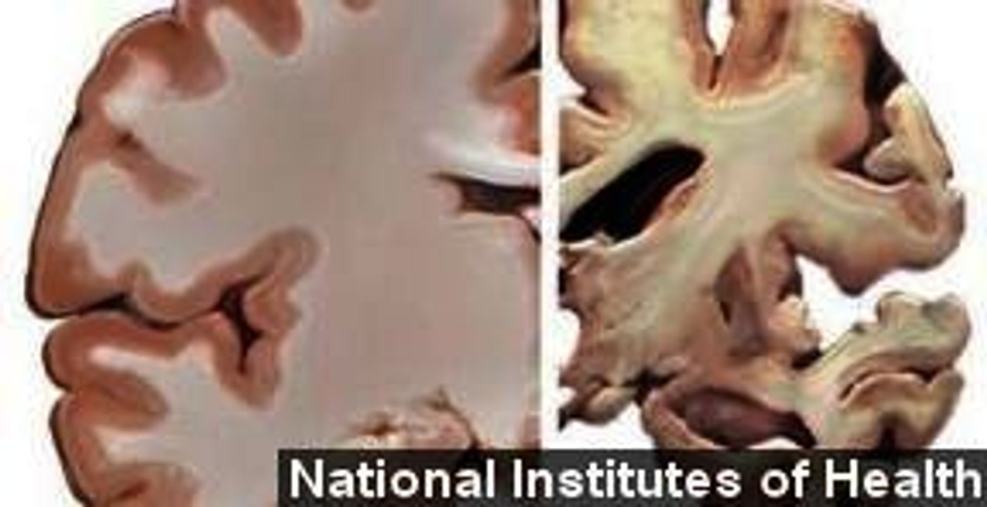 Study Links Alzheimer's Disease With Pesticide DDT