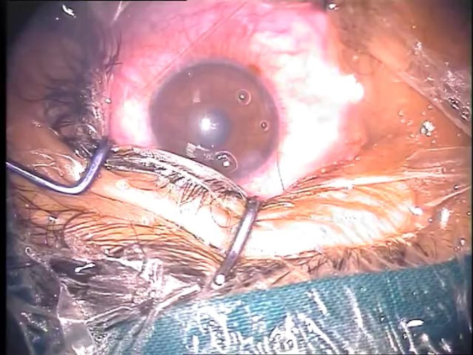 Micro Track Filtration- Surgery to treat Glaucoma by Dr Irfan Kundi