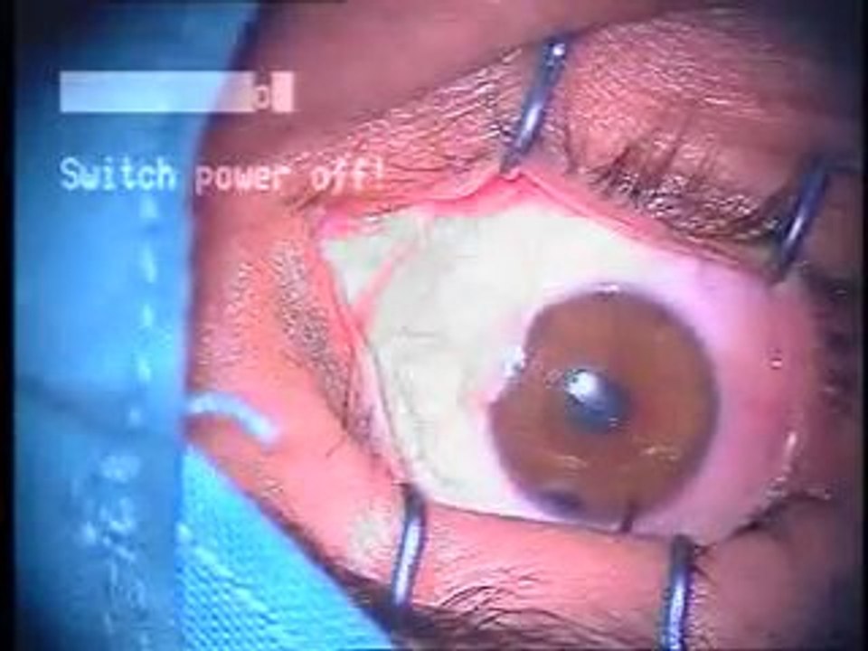 Pterygium e mmc - Eye Surgery - Dr Ifan Kundi