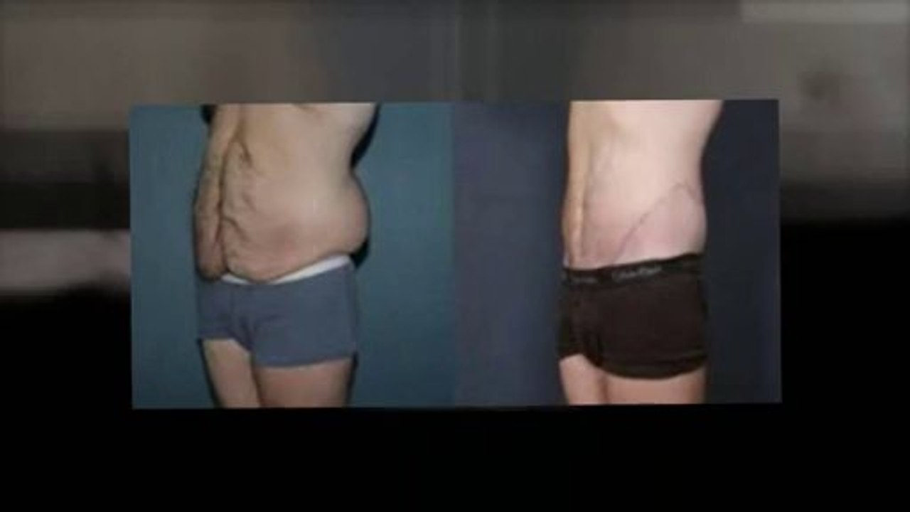 Tummy Tuck Before And After
