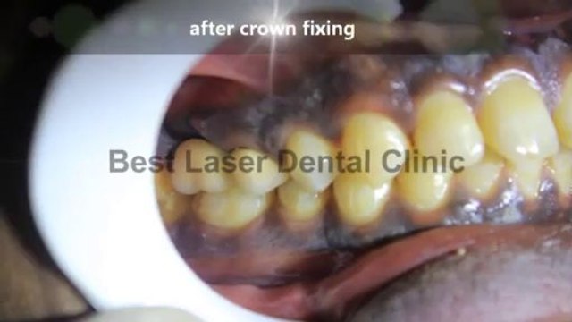 dental implants without sinus lift in india