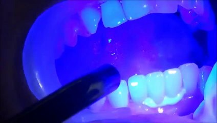 LOWER FRONT SHAKING TEETH -TREATED BY ZIRCONIUM BRIDGE AND IMPLANTS-INDIA-LOW COST