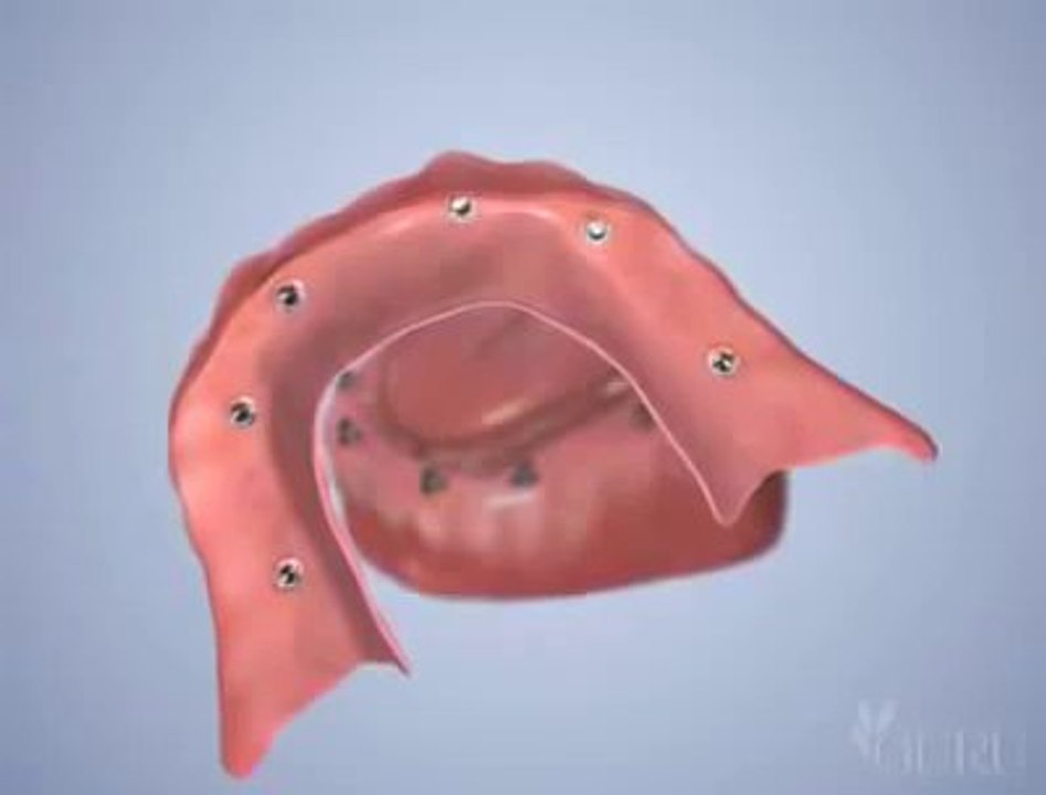 Fixer un dentier sur 6 implants dentaires