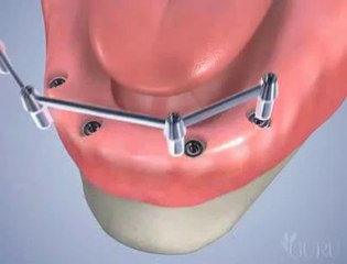 Pose de 4 implants dentaires avec une barre d'attachement