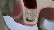 SinusLift, greffe osseuse sinusienne, pose d'implant dentaire
