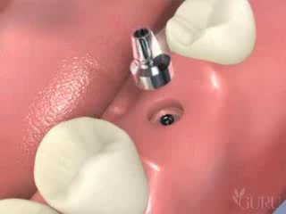 Pose d'un implant dentaire en 2 temps chirurgical en position de molaire