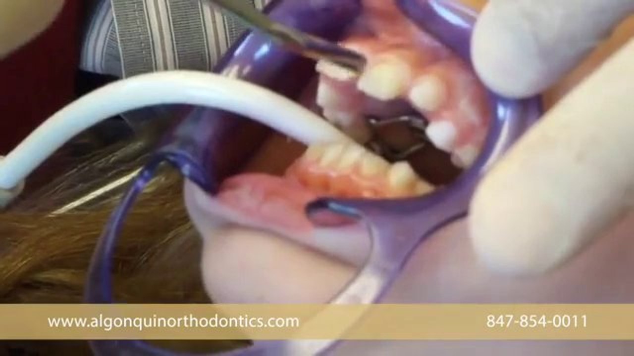 Huntley Orthodontist Dr. O'Byrn putting braces on. Orthodontists in Huntley 60142