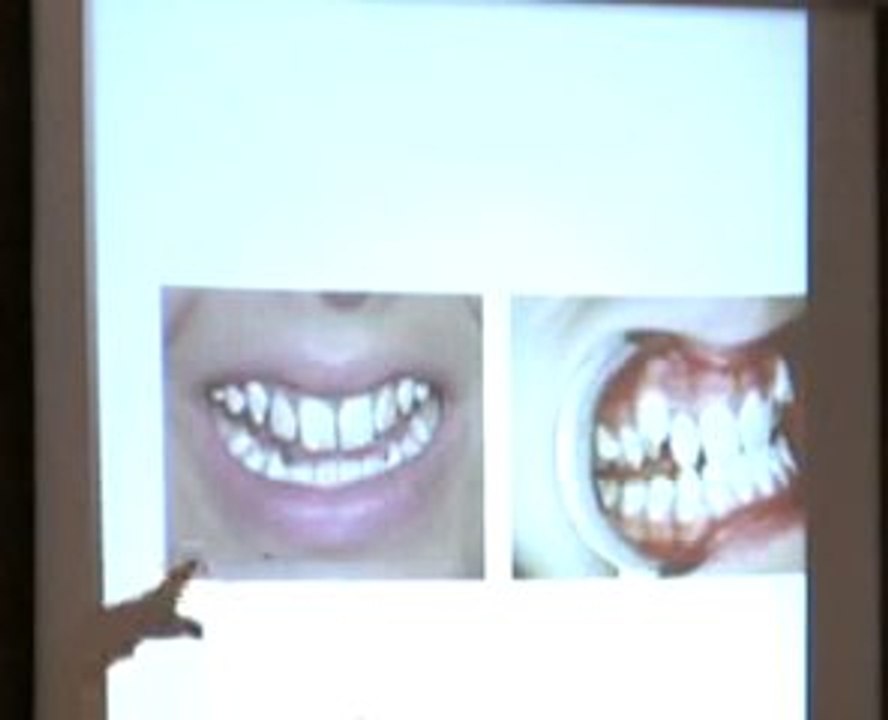 Dr. James Beck Fluoride Discussion