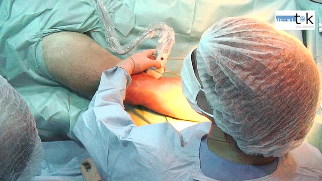 Láser endovenoso. Eliminar varices sin cirugía. Bilbao