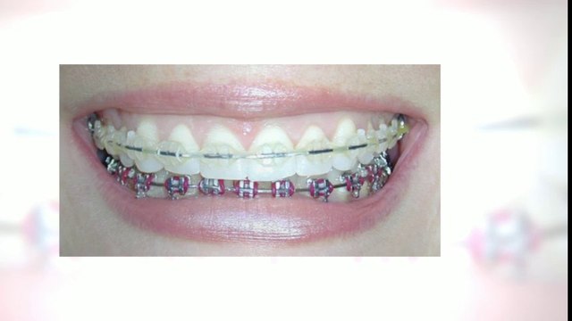 Orthodontis Littleton Nov2013