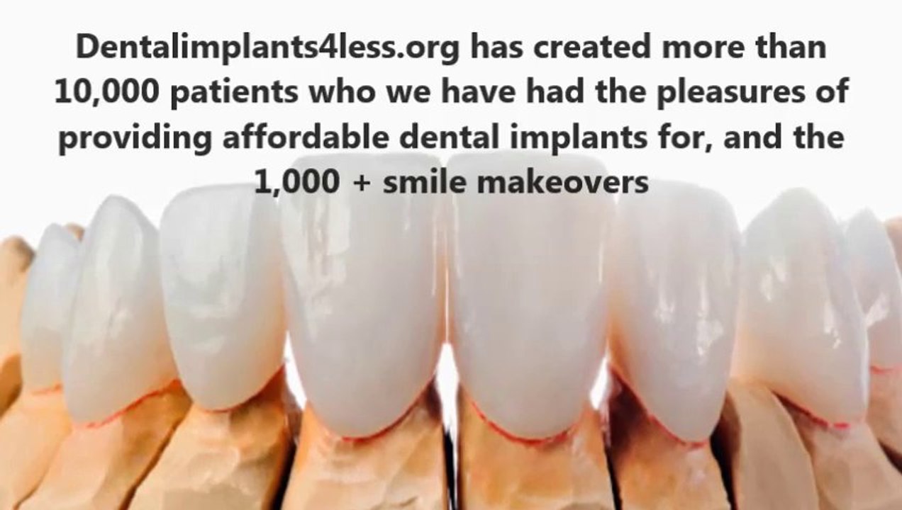 Affordable Dental Implants Miami