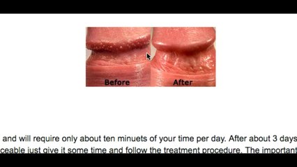 treatment for papules