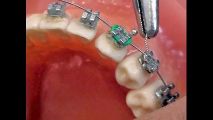Ceramic Braces Service Oakville by Dentistryinoakvilleca  YouTube - Standard Quality 360p [File2HD.com]