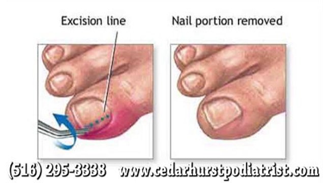 Ingrown Toenail - Podiatrist Arnold Hertz in Cedarhurst, Woodmere and Hewlett, NY
