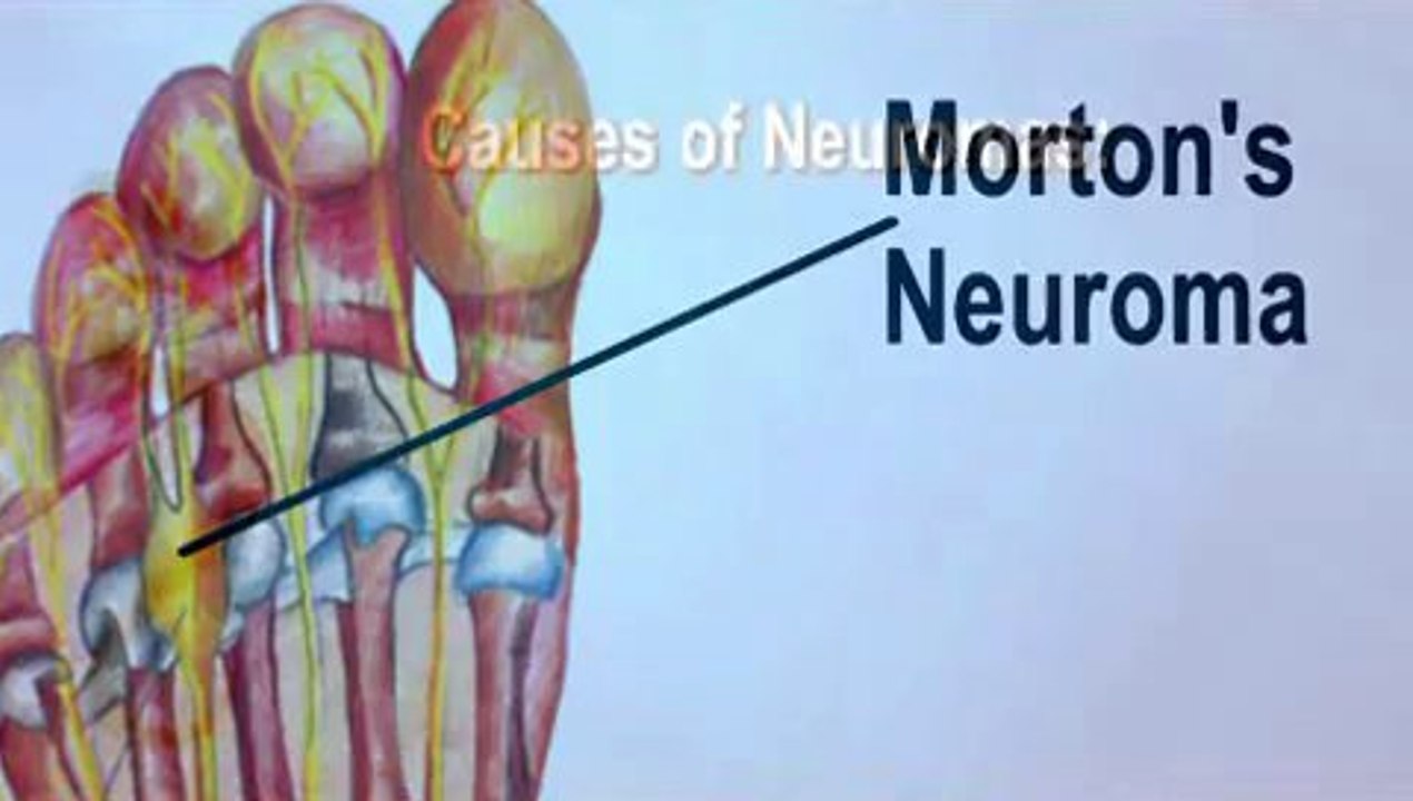 Morton’s Neuroma - Podiatrist in  Prattville, Montgomery. Alabama - Michael Rosenberg, DPM