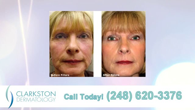Dermal Fillers Birmingham - Clarkston Dermatology