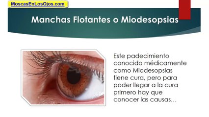Puntos Que Flotan En La Vision: Como Combatir Los Molestosos Puntos Que Flotan En La Vision