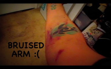 Bruised Arm- Ozcar's Mdrn Life