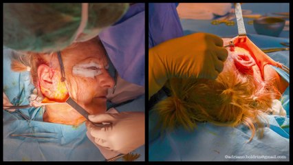 Face and neck lifting